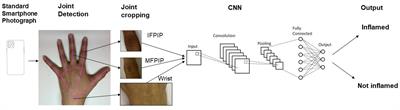 Computer vision detects inflammatory arthritis in standardized smartphone photographs in an Indian patient cohort